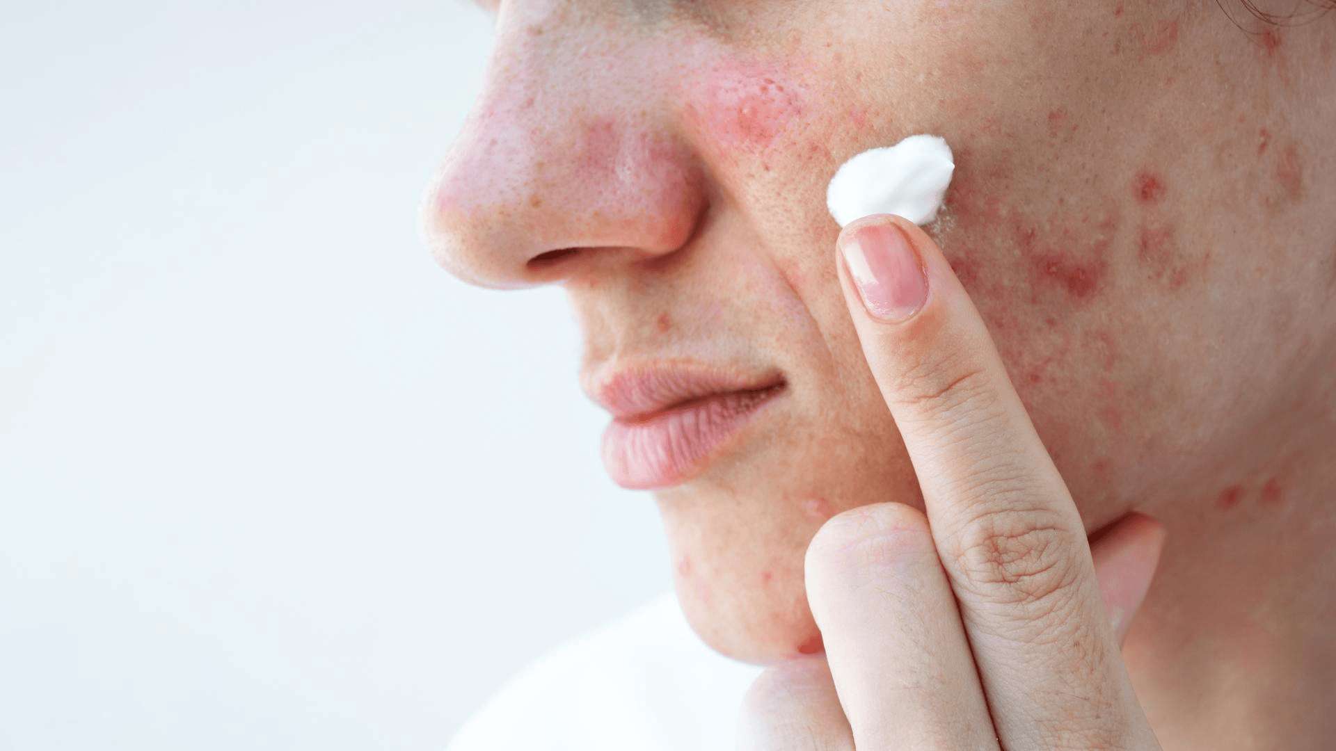 Acne Creams and Alternate Acne Creams