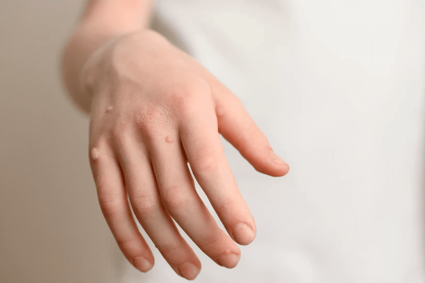 Wart Removal Solutions